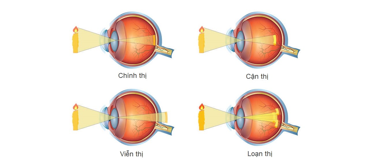 Do nhiều yếu tố, tình trạng tật khúc xạ ngày càng gia tăng. Theo thống kê của ngành y tế hiện nay, tại các khu vực nội thành của Hà Nội và TP Hồ Chí Minh. Tỷ lệ mắc các bệnh về mắt như tật khúc xạ ở học sinh chiếm trên 40% trong tật khúc xạ như: Cận - viễn - loạn thị. Trong đó, cận thị chiếm tới 2/3 trên tổng số ca mắc.